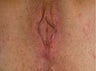Vaginal Rejuvenation
