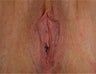 Vaginal Rejuvenation