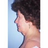 Neck Lift
