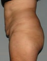 10 weeks after liposuction and SlimLipo laser
