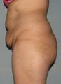 10 weeks after liposuction and SlimLipo laser