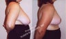 32 Year Old Female, Breast Reduction for Hypermastia (Breast Hypertrophy)