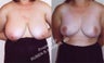 32 Year Old Female, Breast Reduction for Hypermastia (Breast Hypertrophy)