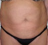 Tummy Tuck