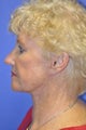 Woman, skin rejuvenation with injectable fillers