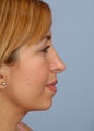 Female Chin/Neck Liposuction
