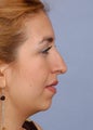 Female Chin/Neck Liposuction