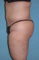 Circumferential Body Lift