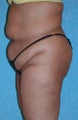 Circumferential Body Lift