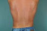 Smart Lipo