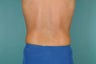 Smart Lipo