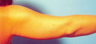 Arm Liposuction
