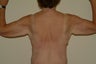 Brachioplasty