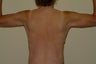 Brachioplasty