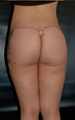 Buttock Lift