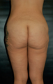 Buttock Lift