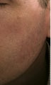 Cheek vessels treated with pulsed dye laser (PDL)