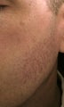 Cheek vessels treated with pulsed dye laser (PDL)