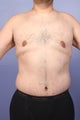 37 yr old weight loss patient