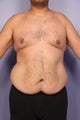 37 yr old weight loss patient