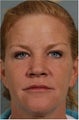 46 year old female with crows feet, loss of lip volume with smokers lines, heaviness of upper eye lids