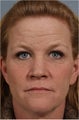 46 year old female with crows feet, loss of lip volume with smokers lines, heaviness of upper eye lids