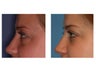 34 year old woman with thyroid eye disease treated for puffy lower lids