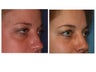 34 year old woman with thyroid eye disease treated for puffy lower lids