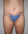 36 year old Woman with Full Body Lift