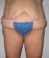 36 year old Woman with Full Body Lift