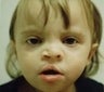Toddler who underwent ear surgery