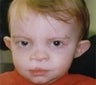 Toddler who underwent ear surgery