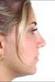 Rhinoplasty