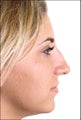 Rhinoplasty