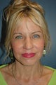 Facelift