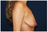 Breast Lift