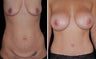 Before and After Mommy Makeover with Breast Augmentation and full Tummy Tuck