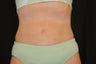 CoolSculpting to lower abdomen and hip rolls
