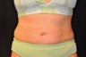CoolSculpting to lower abdomen and hip rolls
