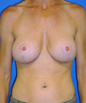 Breast Revision