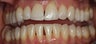 Treatment with Invisalign® (Clear Braces)