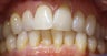 Treatment with Invisalign® (Clear Braces)