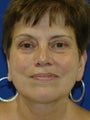 Lower Facelift and Necklift with Platysmaplasty