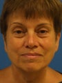 Lower Facelift and Necklift with Platysmaplasty