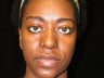 Atlanta Rhinoplasty Patient