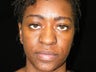Atlanta Rhinoplasty Patient