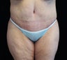 Body Lift