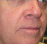 mole removal