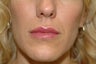 Lip augmentation