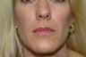Lip augmentation